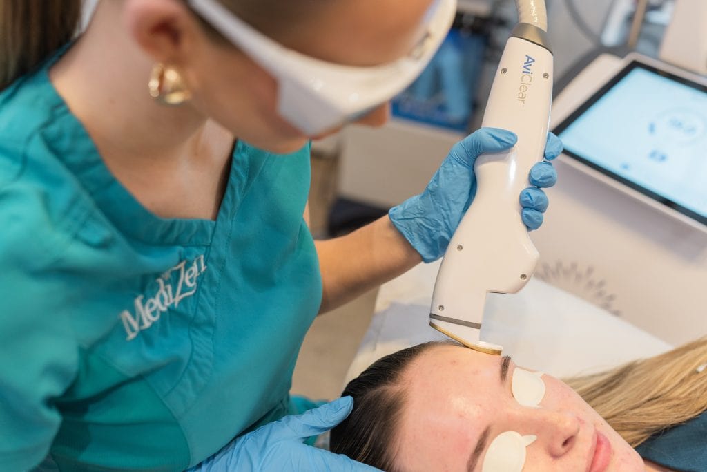AviClear Acne Laser